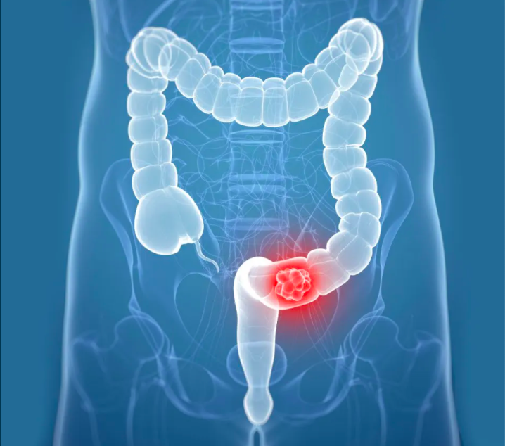 As the second leading cause of cancer-related deaths world wide, colorectal cancer represents a high unmet medical need. CTSA support helped lead to a start-up—EV Therapeutics—that is developing a promising new treatment strategy for late-stage colorectal cancer.