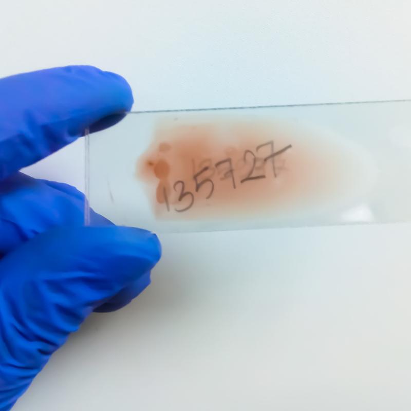 Technician's hand hold blood smear for hematological analysis.